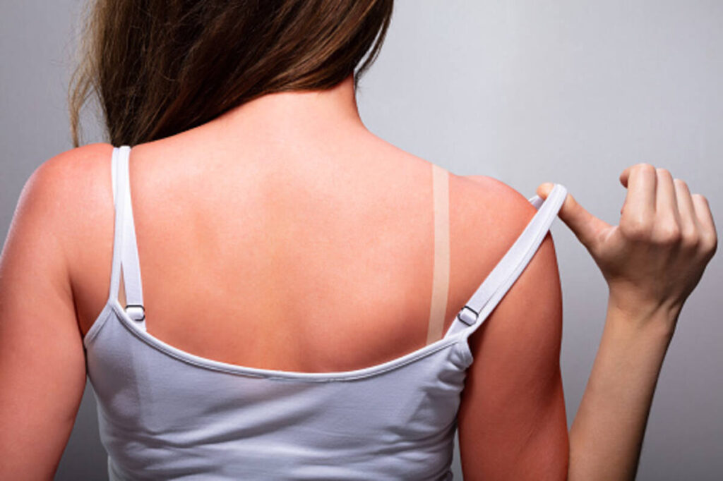 heat rash