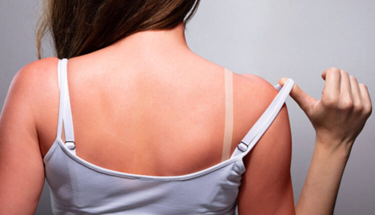 heat rash