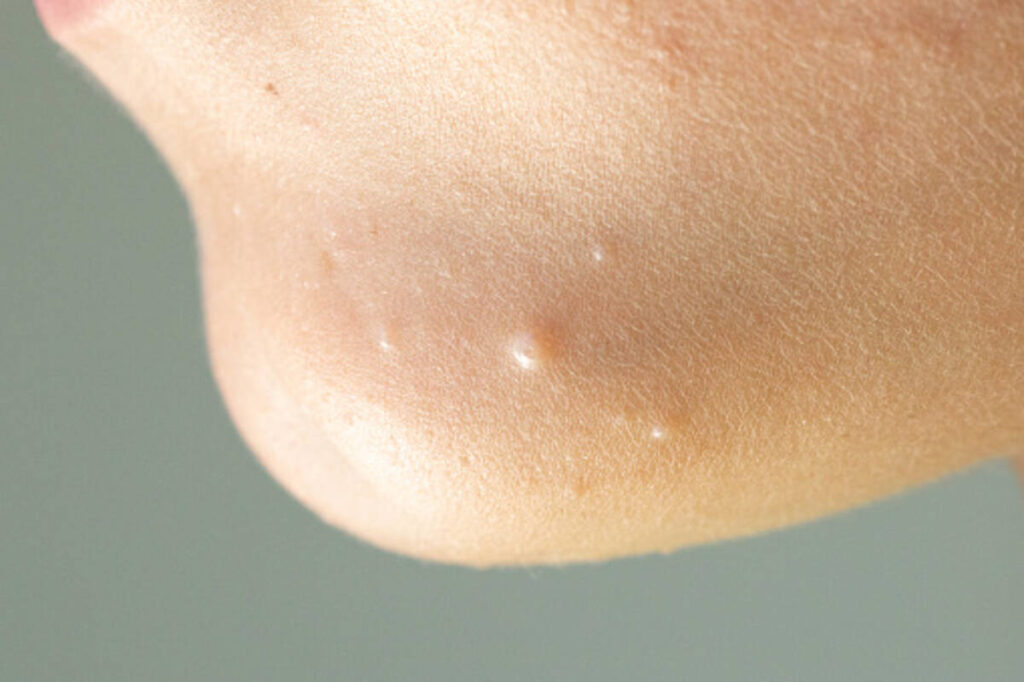 molluscum contagiosum