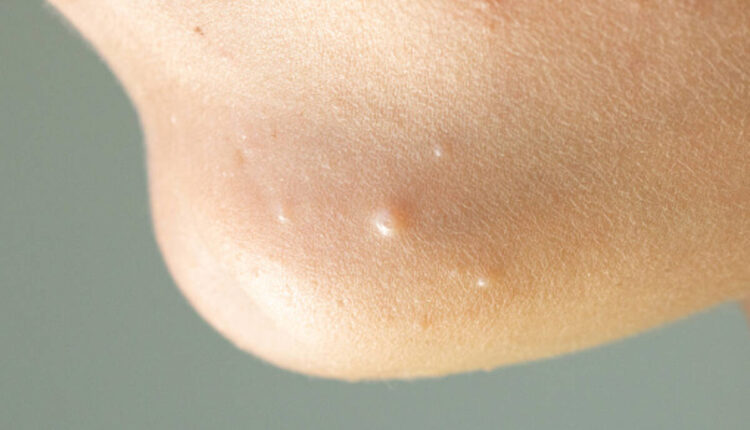 molluscum contagiosum