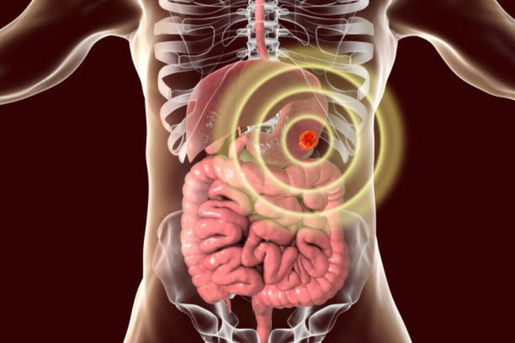 stomach cancer