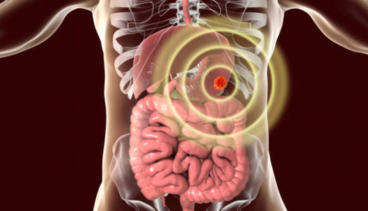 stomach cancer