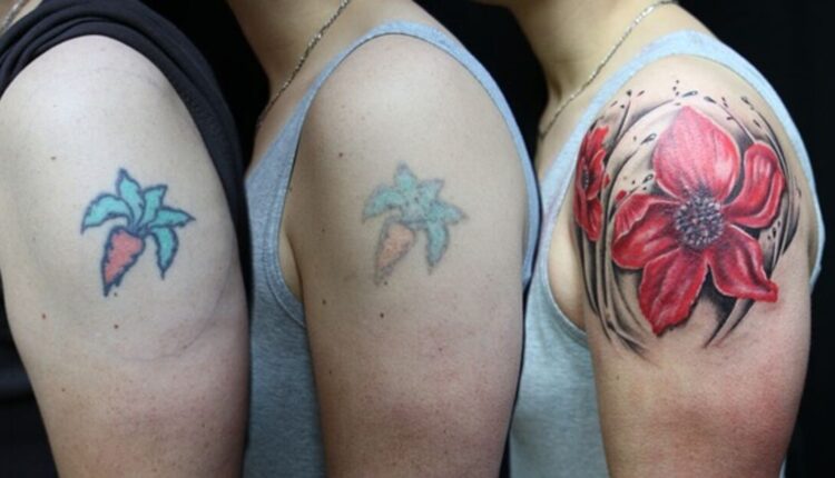 Tattoo Removal